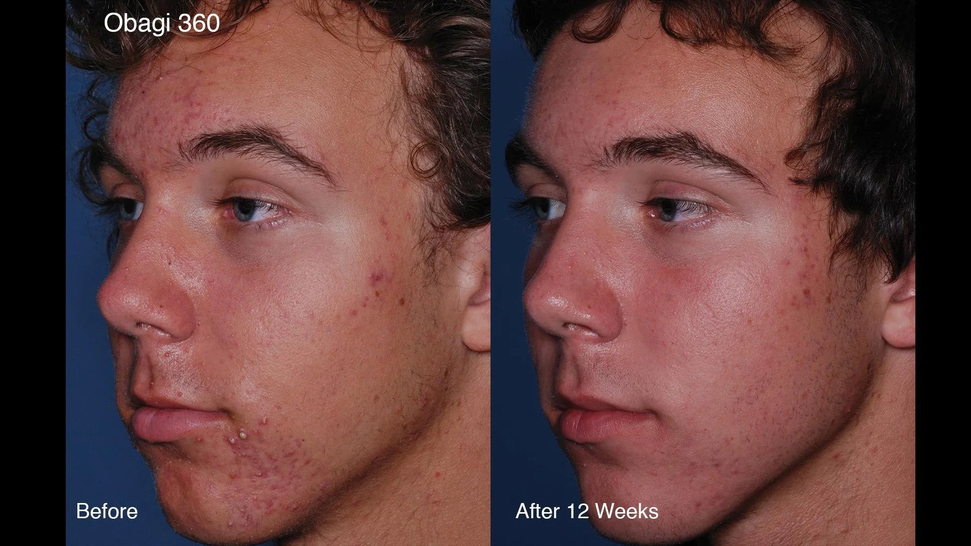 CLENZIderm Daily Foaming Cleanser